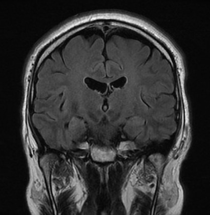 正常MRI